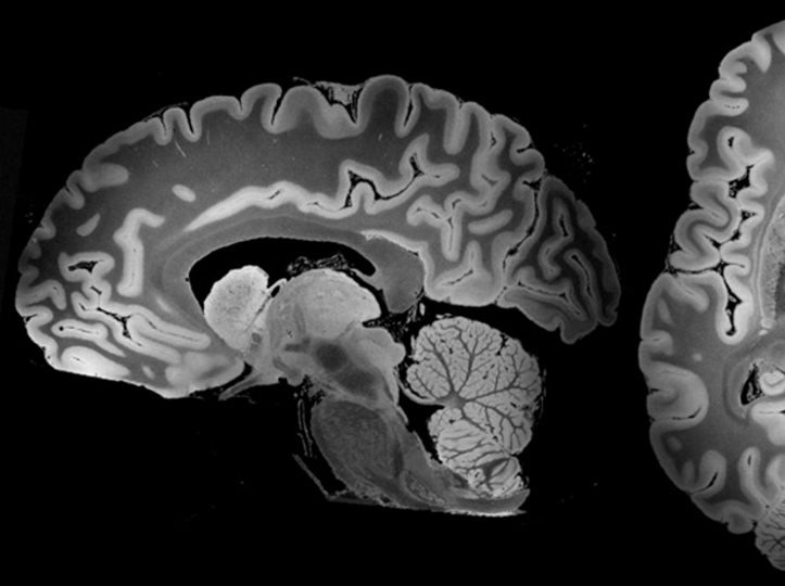 A 100-hour MRI scan captured the most detailed look yet at a whole human brain