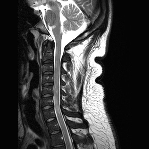 Diagnosing Multiple Sclerosis With MRI