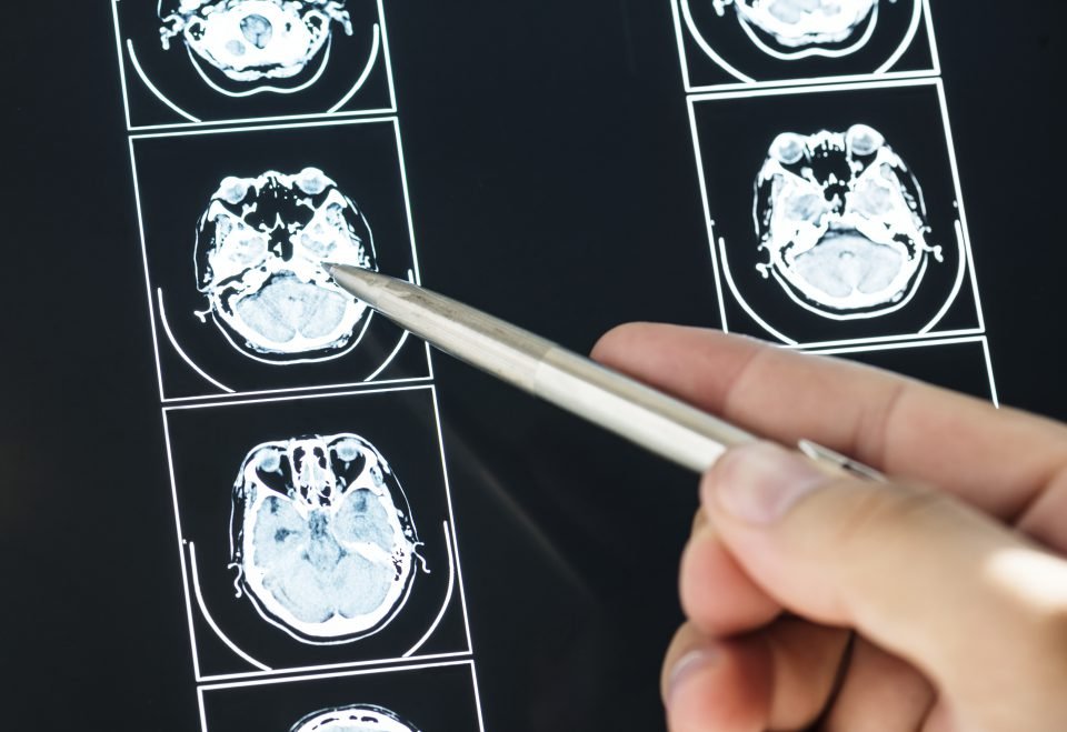 Study Shows Facial Nerve Atrophy Seen on High-resolution MRI Helps Diagnose ALS in Early Stages