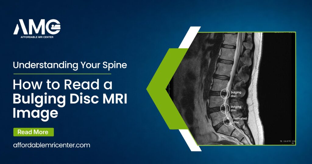 Bulging Disc MRI Image